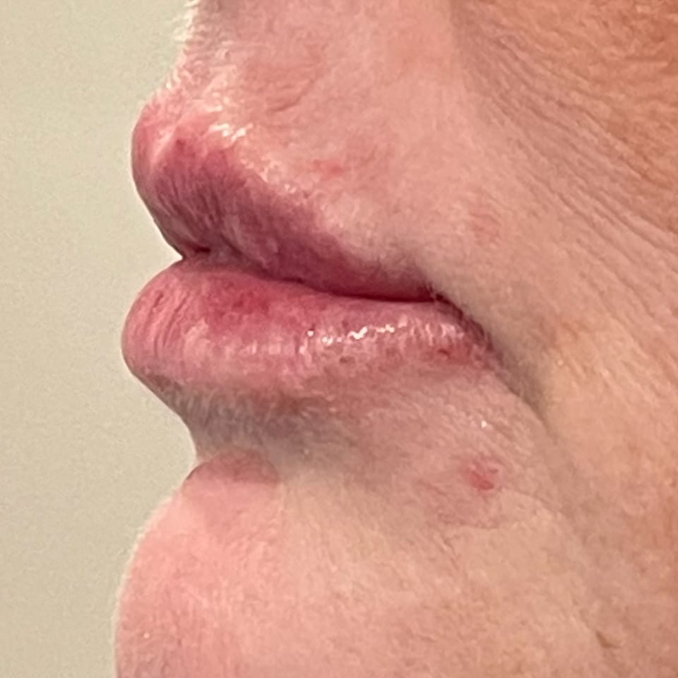 After Image: Lip Filler - left-side