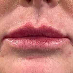 Lip Filler