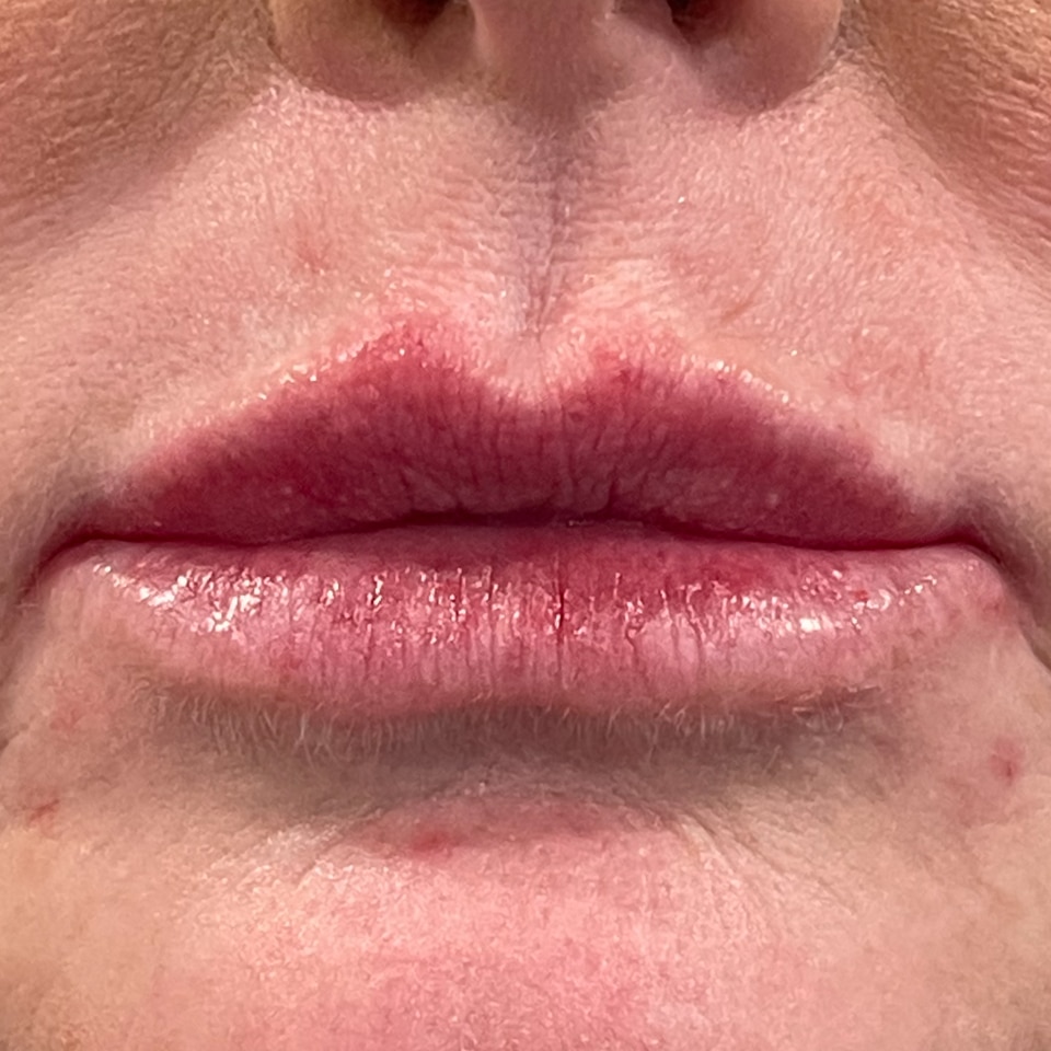 After Image: Lip Filler - front