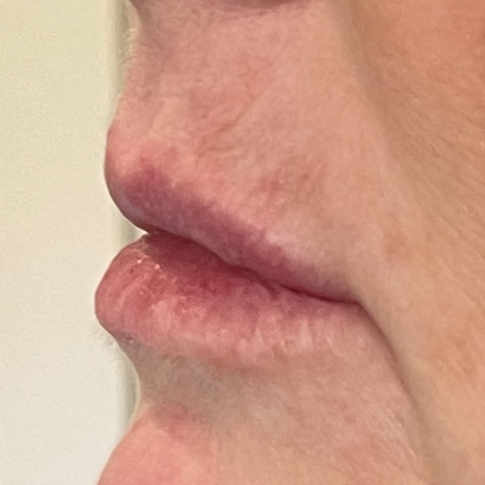 Before Image: Lip Filler - left-side