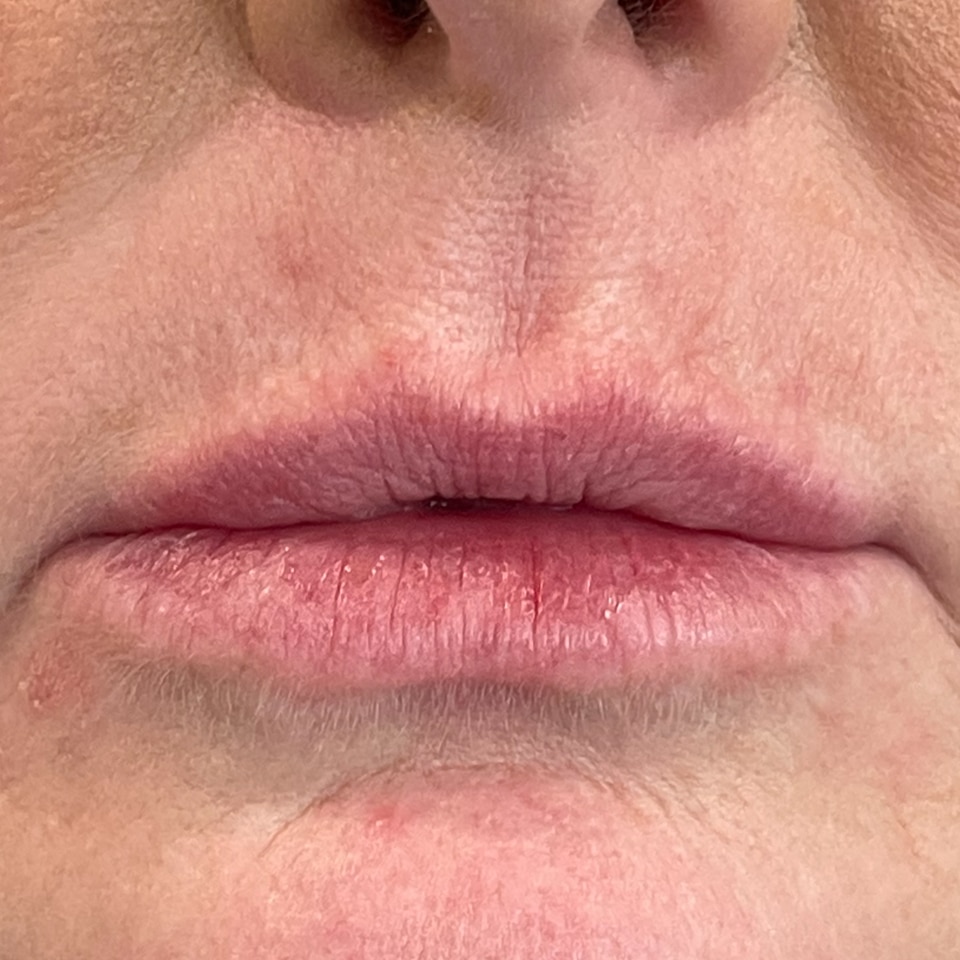 Before Image: Lip Filler - front