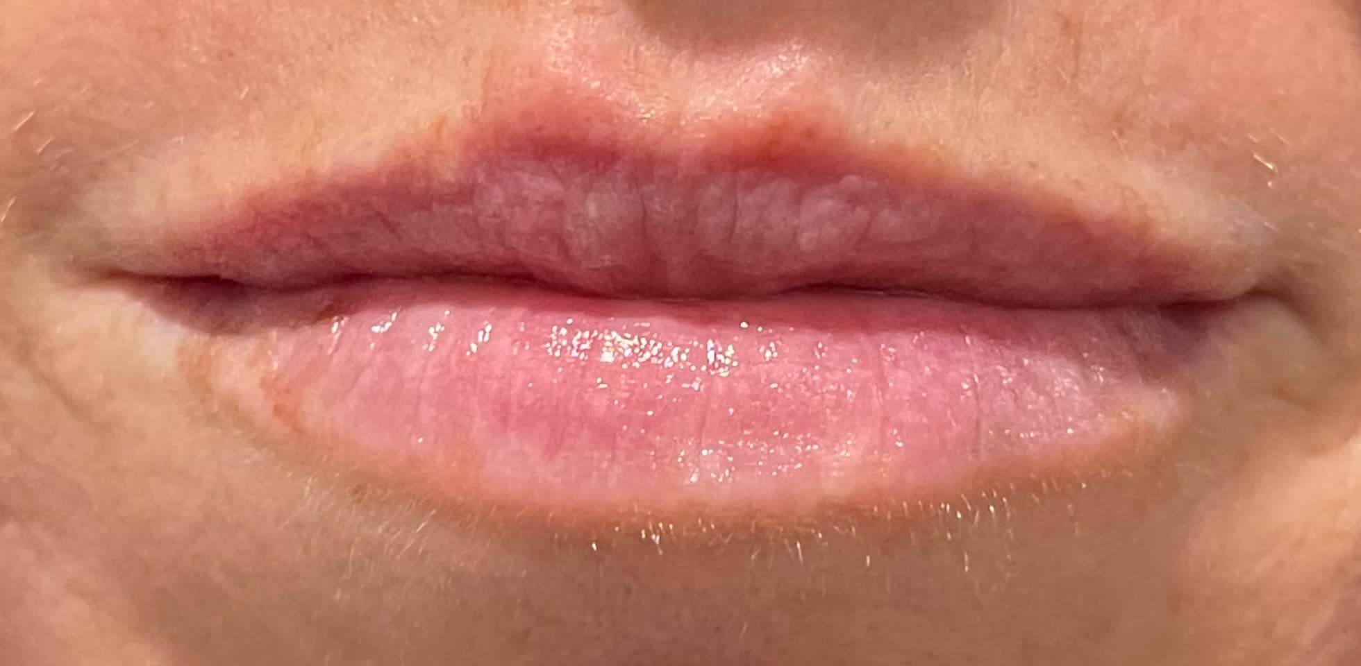 After Image: Lip Filler - front