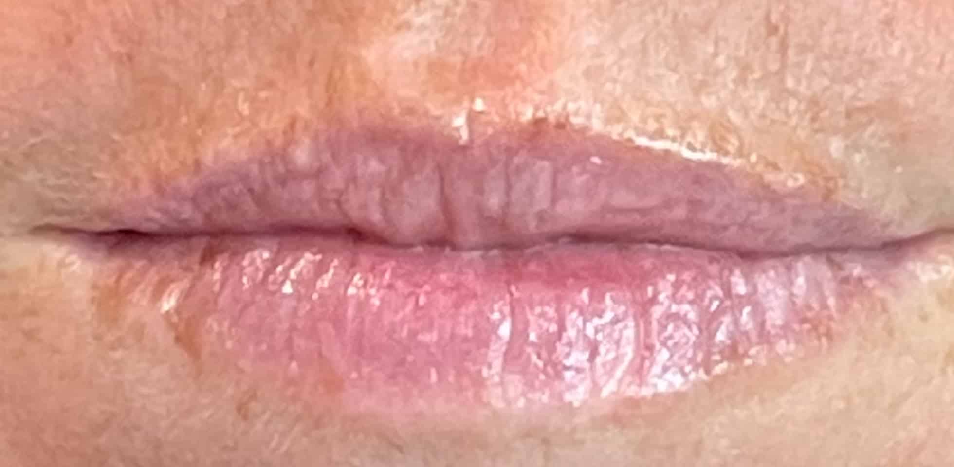 Before Image: Lip Filler - front