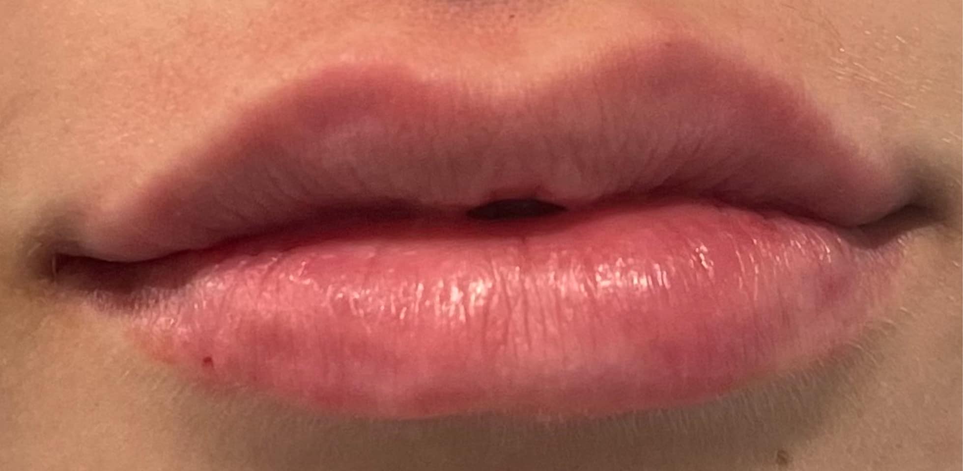 After Image: Lip Filler - front