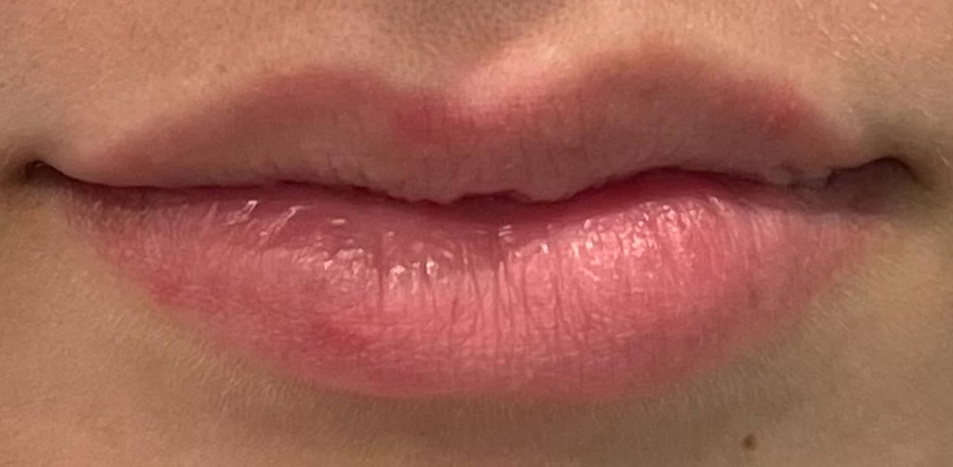 Before Image: Lip Filler - front