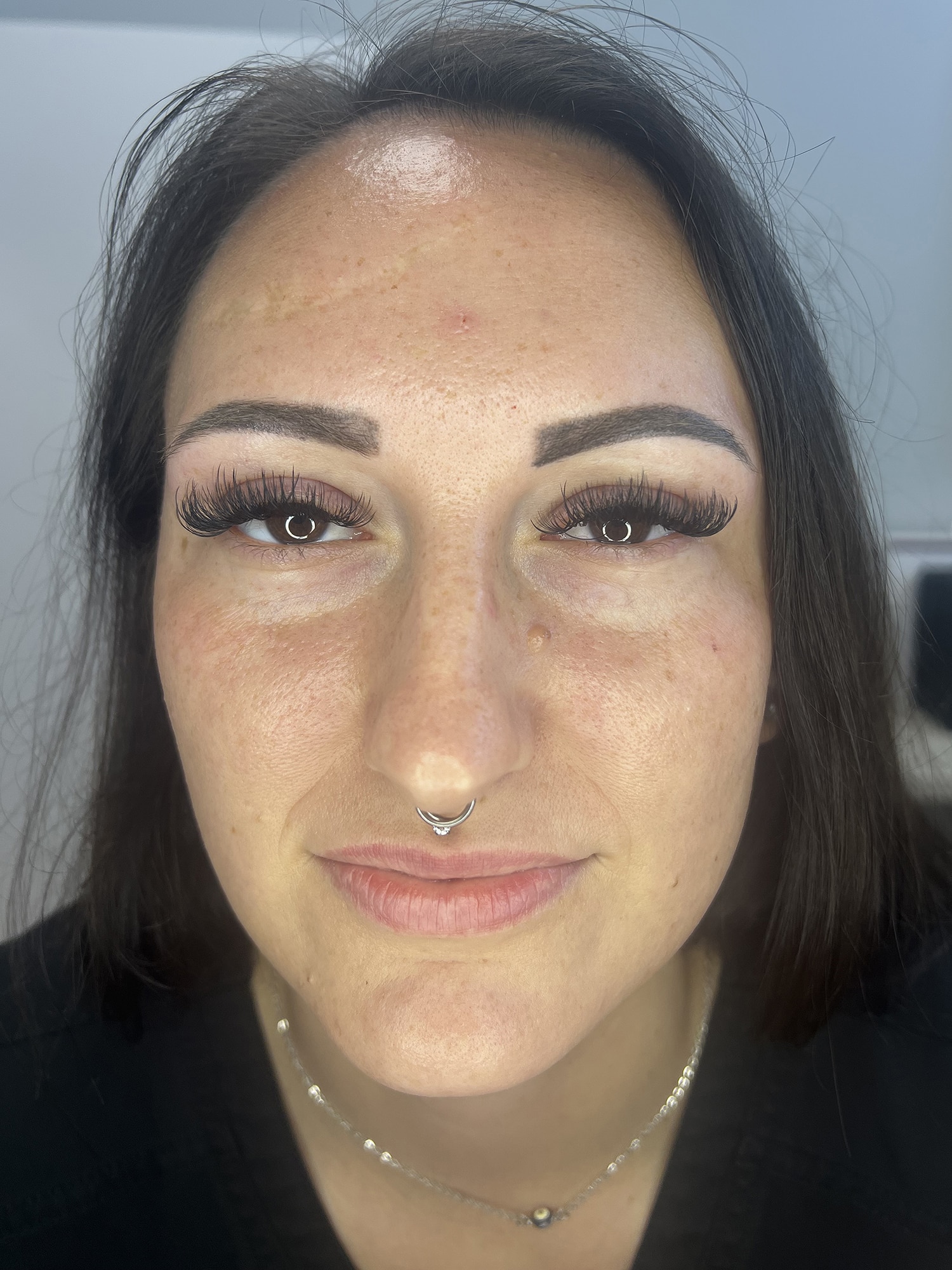 After Image: Microneedling - front