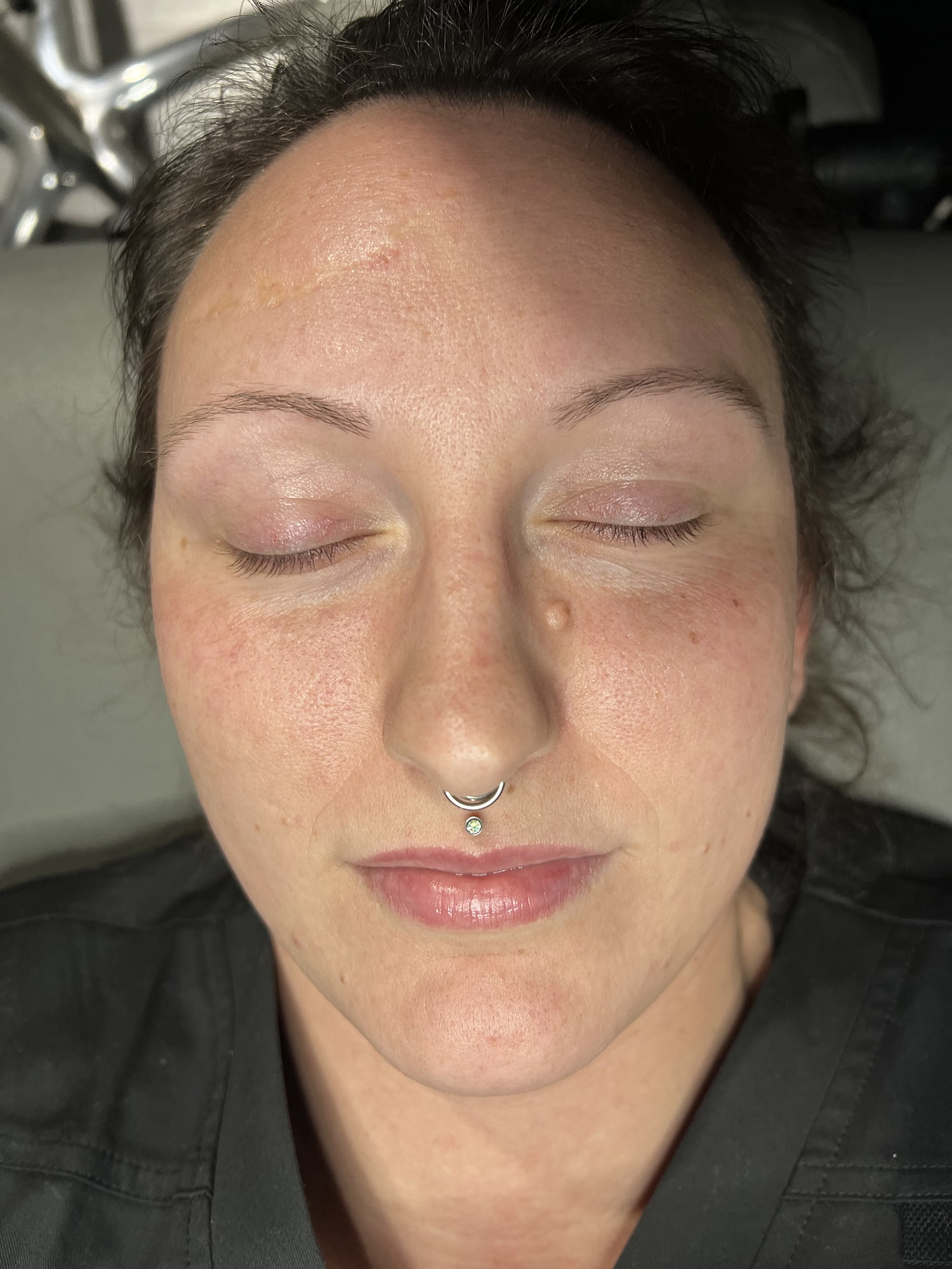 Before Image: Microneedling - front