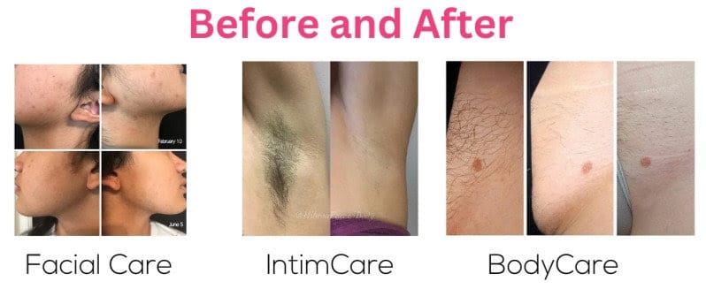 1763604893_BeforeandAfterEpilFree 1763604893 BeforeandAfterEpilFree 1